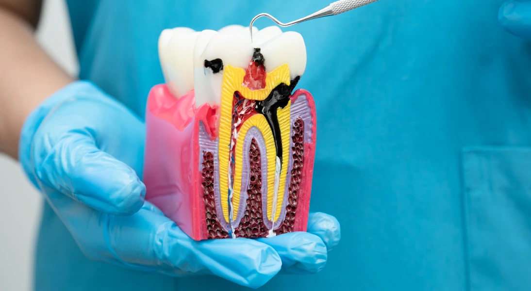 Endodoncia especialidad clinica dentala
